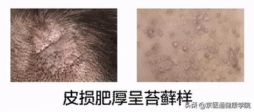 7种皮肤病又红又痒,积水潭医生教你对图自查(附治疗方法)