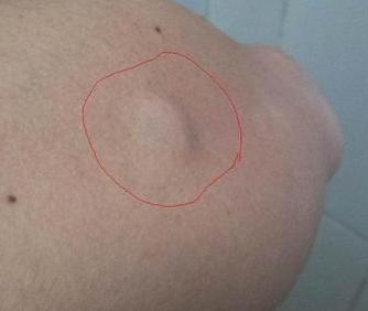 皮下脂肪瘤的临床表现