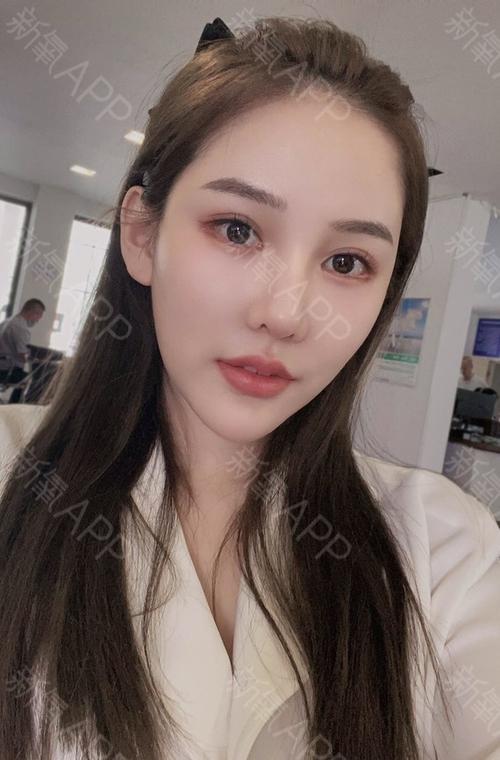 转眼间做完眼睑下至快一年咯~眼睛依旧是那么美腻,每