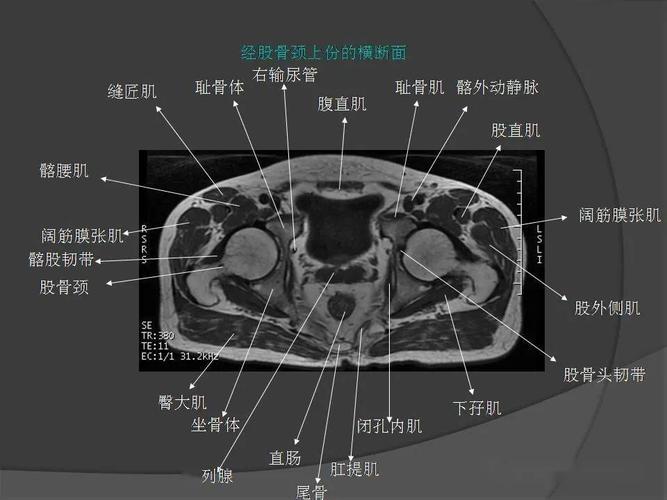 骨盆肌肉mri断层解剖