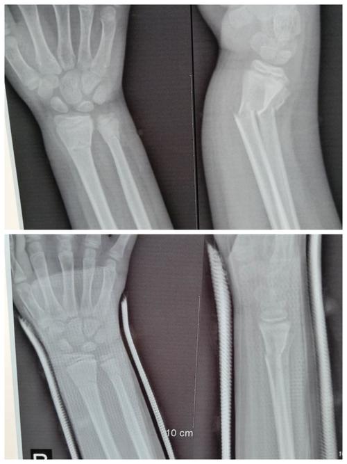 (四)2020-06,儿童尺桡骨远端骨折 经手法整复,小夹板固定.