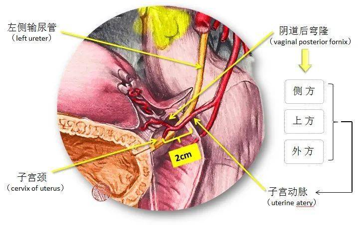 医学图说桥下流水子宫动脉与输尿管的交叉关系