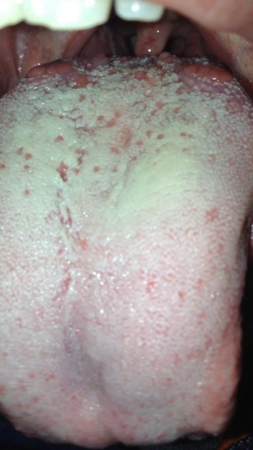 舌头上长了很多小泡泡,蛮吓人的.是在靠近喉咙的部分.