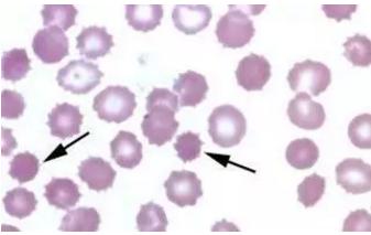 那些年,曾经被混淆过的红细胞