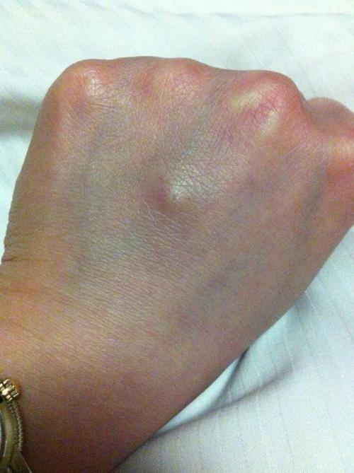 手背上长了一个包,,按上去硬的,用力按会