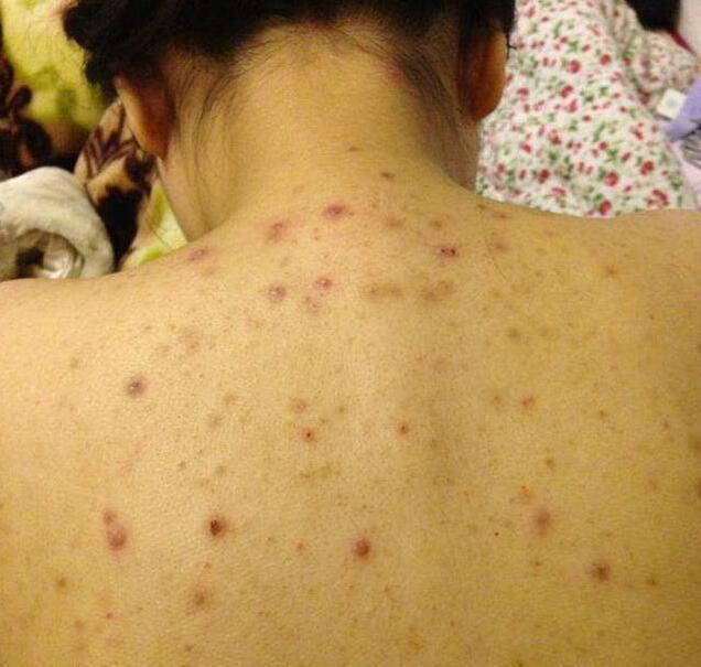 在后背一直能扣出"米粒",说明后背螨虫上亿,坚持3招能