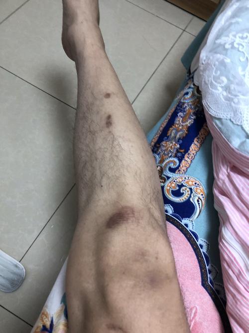 一直是黑的有人说我是糖尿病.我29怎么能得这病?