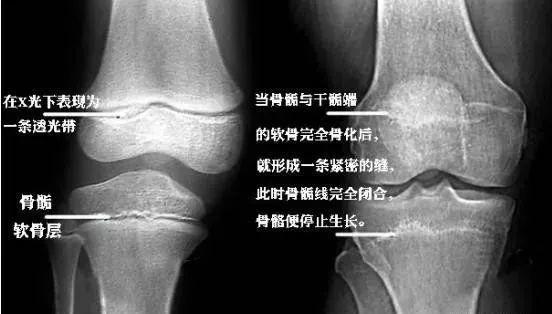 当骨骺线完全骨化不再生长时,骨骼也就停止生长, 人体的身高也就基本
