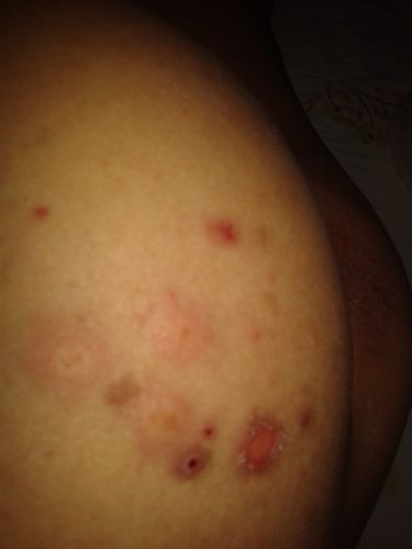 屁股上长红疱(痘痘)