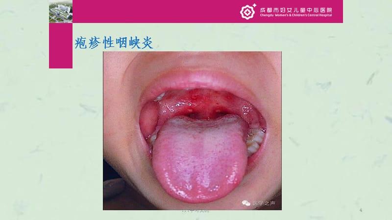 手足口病和疱疹性咽峡炎课件