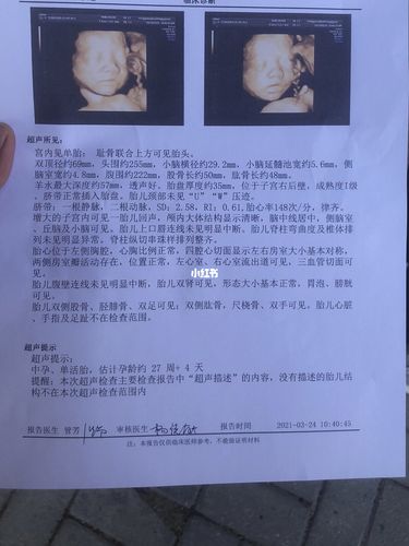 四维b超_四维彩超_胎儿_母婴_孕产经验