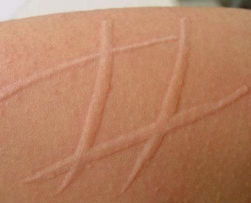 教你一文读懂"荨麻疹"