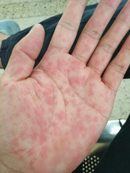 刚开始手掌有红点怎么回事,还有点痒,现在腿上,和屁股也有了