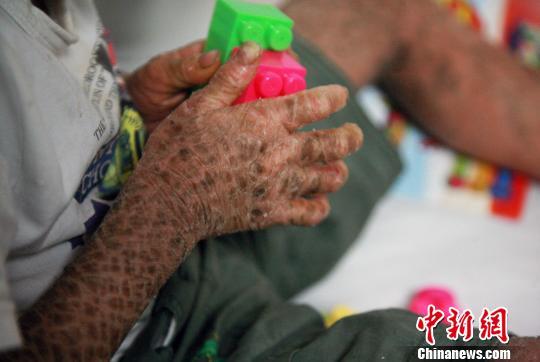 多方专家会诊树皮男孩称有效改善是持久战