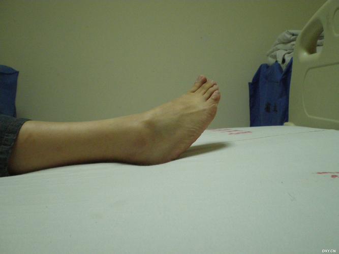 儿麻后遗症,跟腱短缩内翻