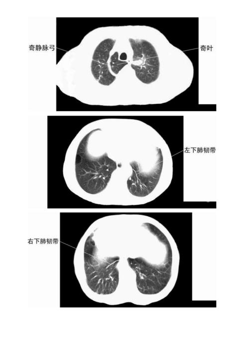 胸部ct肺段划分口诀doc