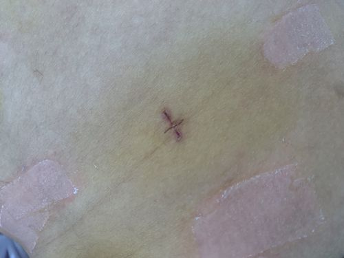 我们再来看一下,普通胃穿孔手术与微创手术对比