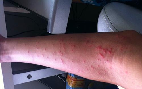 艾滋病初期症状有哪些?