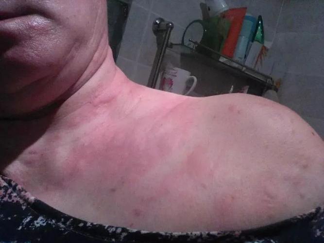 【科普】同是荨麻疹,类型各不同!症状对比仔细看!