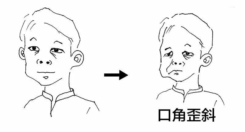 下意识地流口水 (中医叫"流涎"),口角歪斜; 2.