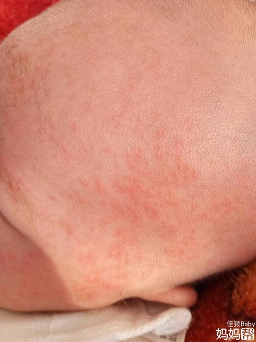  会不会可能是牛奶过敏?