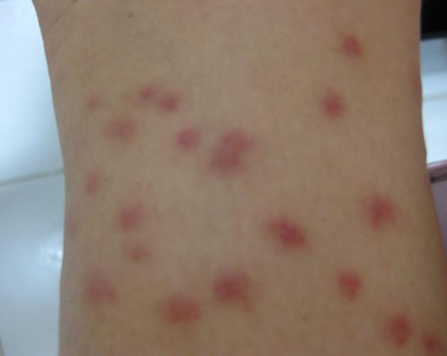 身上起红疙瘩 开始象蚊子咬的一样 痒死啦