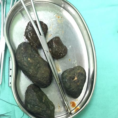 经常听说谁谁得了胆结石,肾结石,怎么没听过有得胃结石,肠结石,膀胱