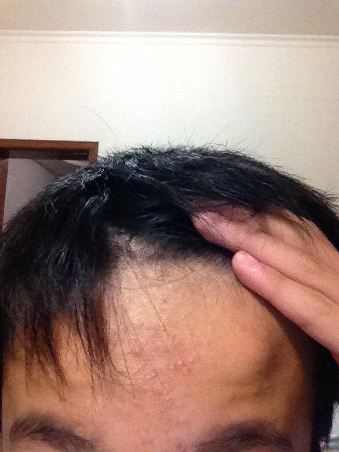 额头长包硬硬的凸起 额头长肉瘤