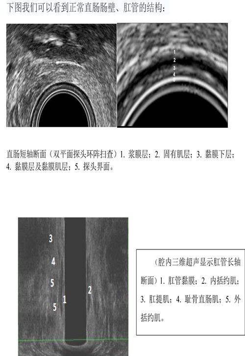 直肠超声那些事儿