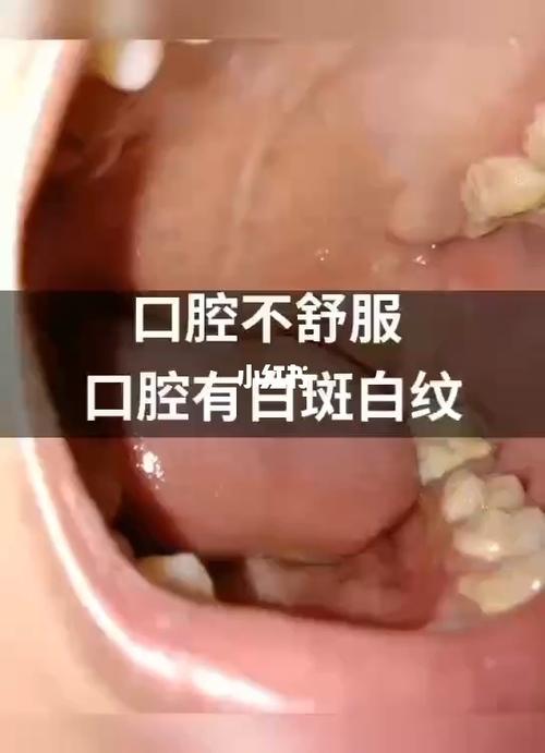 口腔不舒服口腔有白斑白纹怎么办?_口腔_医疗健康