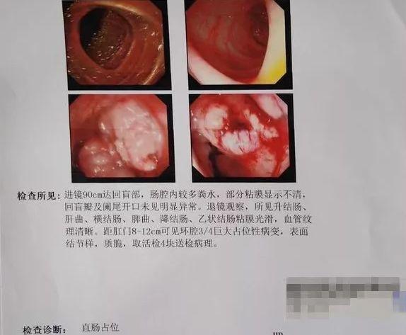 女子大便变细次数增多,一查竟是结肠癌!结肠癌早期有哪些信号?