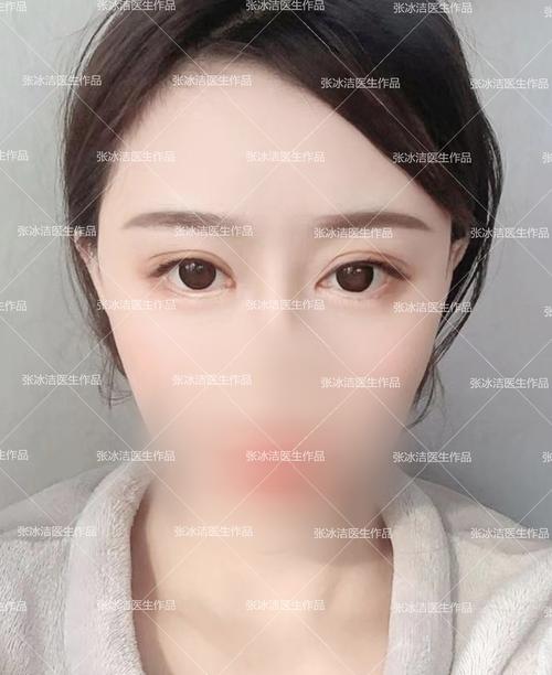 张冰洁内眼角修复案例丨单侧内眼角开的过大,泪阜暴露