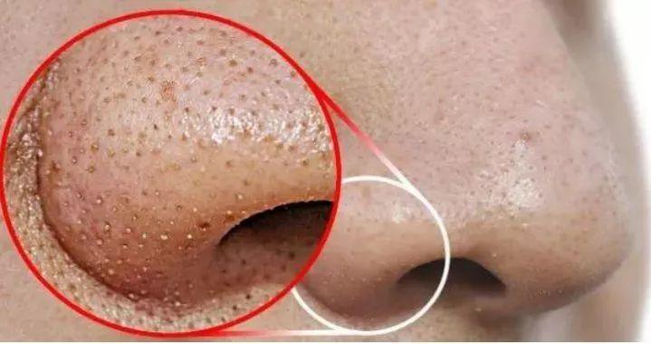 拒绝"螨虫脸"!5秒揉一揉,螨虫全出来了,痘痘黑头全没了!