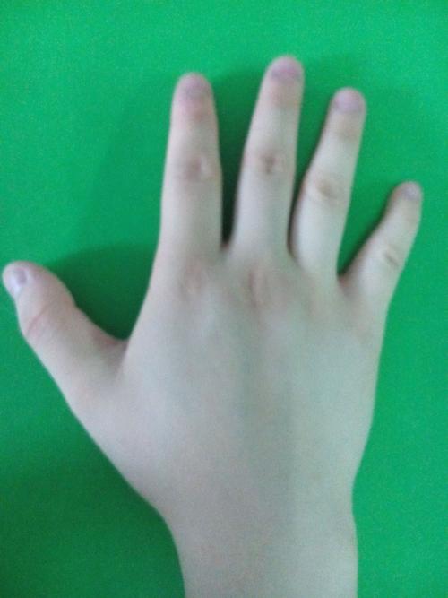 其他地方都蛮瘦就是这手和脚"tut 这是不是肢端肥大症