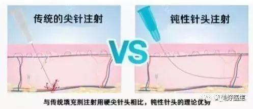 目前国内多数都是用锐针进行玻尿酸的注射,如果医生技术不到位,稍有