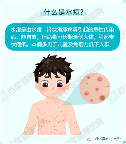 卫生保健惠安县东桥中心幼儿园预防水痘健康知识宣传