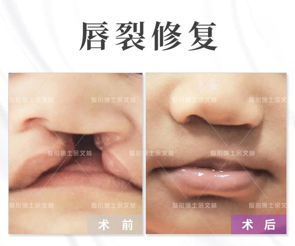 兔唇会遗传吗兔唇遗传的规律