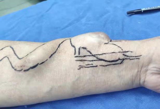 西安高新医院透析室成功为长期透析患者切除内瘘动脉瘤并修补再造