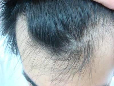 两鬓长白发正常吗 两鬓长白头发预示早衰