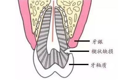 牙齿为什么会出现楔形缺损