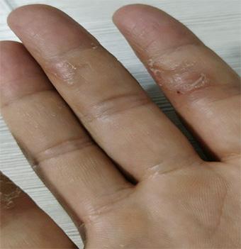 手指腹痒得脱皮湿疹图片