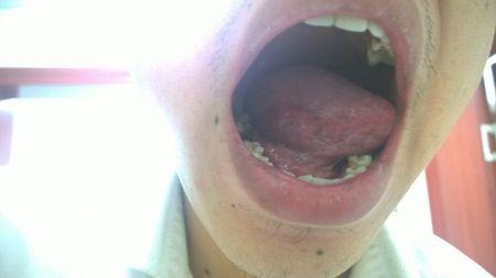 1主要病症:舌头上长了一个小包,不痛不痒,小拇指大小.