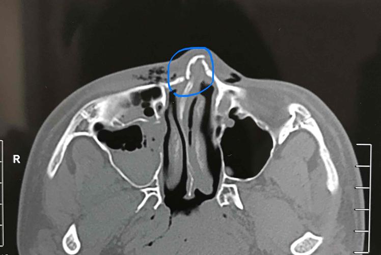 鼻骨骨折怎么办