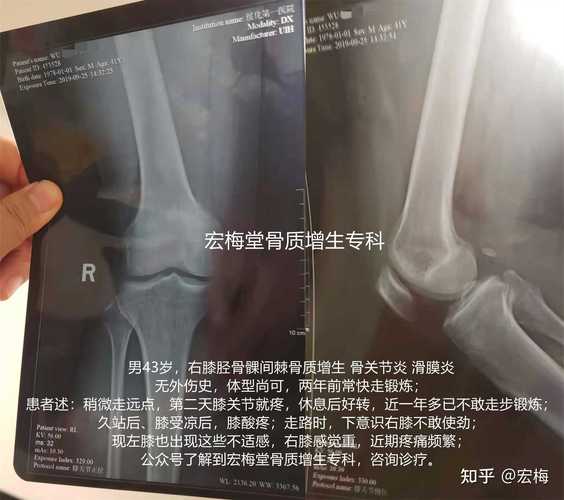 男43岁右膝胫骨髁间棘骨质增生骨关节炎滑膜炎