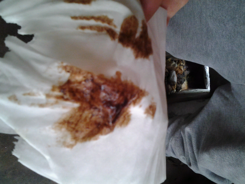 褐色分泌物淋漓不尽.