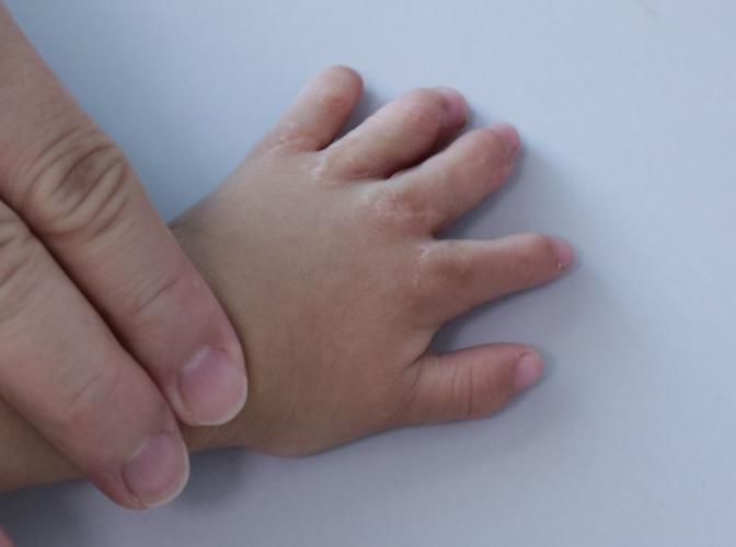 波兰综合征的孩子来复查了,恢复得很不错!