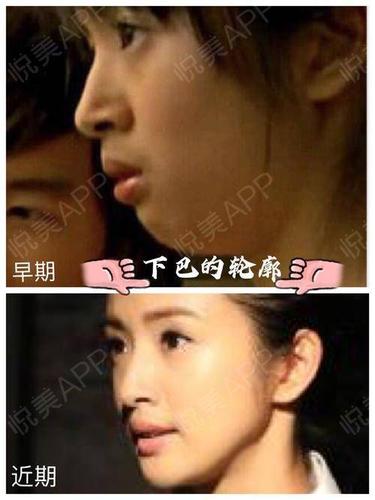 对比现在可以发现林依晨的下巴后缩问题得到了明显的改善,下颌轮廓