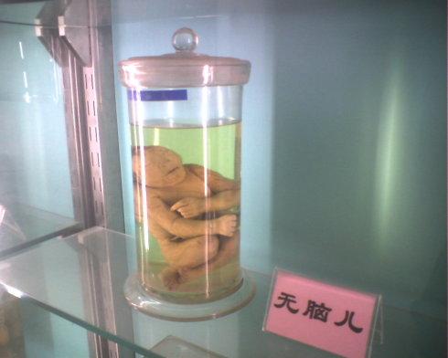 北大医学部里的畸形胎儿(图)