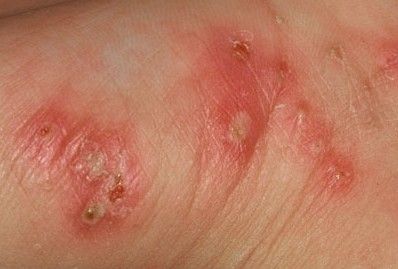 怎样治疥疮效果好