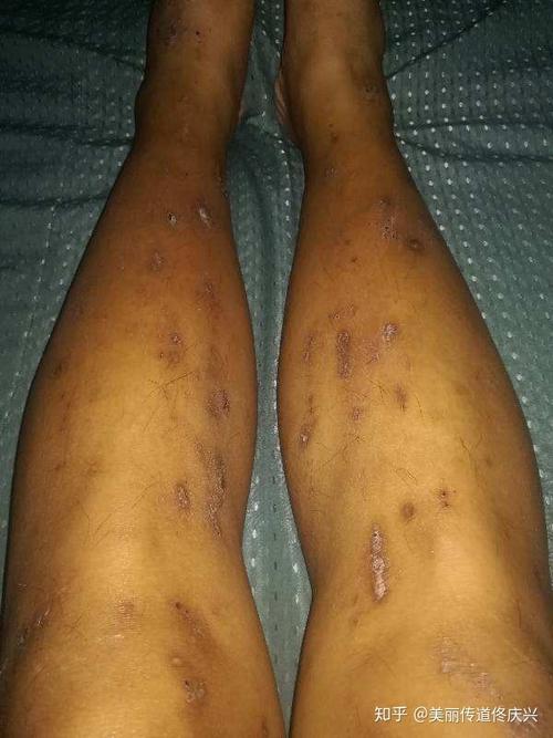 胫骨斑(糖尿病性皮肤病)